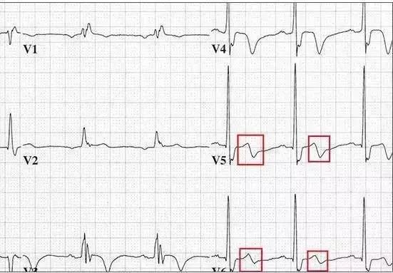 电机械分离在心电图上的表现及相关探讨研究综述